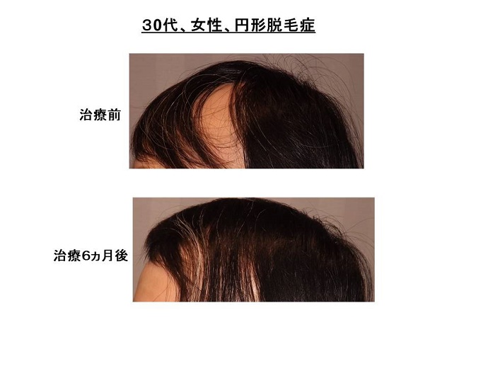 円形脱毛症　病院""